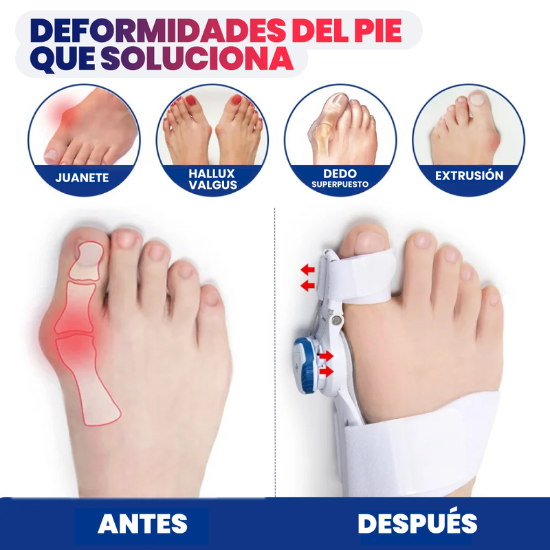 CORRECTOR DE JUANETE ORTOPÉDICO